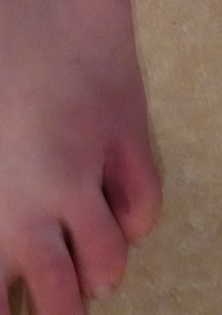 Broken toe