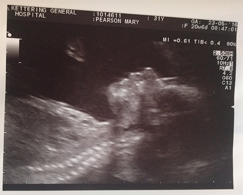 Baby scan at 20w 6d