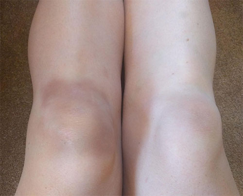 Bruised knee
